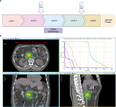 Case Report: Pathologic Complete Response to Induction Therapy in a Patient With Potentially Resectable Pancreatic Cancer